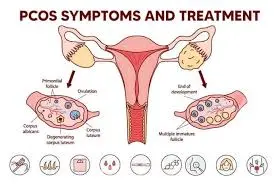 متلازمة تكيس المبايض (PCOS) صحة المرأة السعودية
